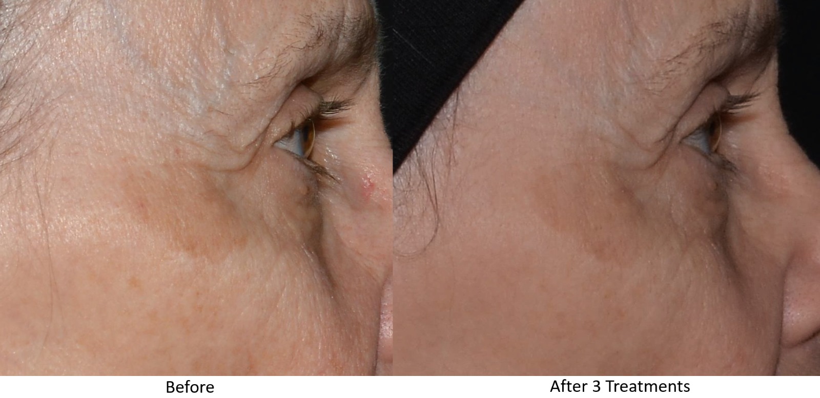 LaseMD Ultra Before and After - Male Patient